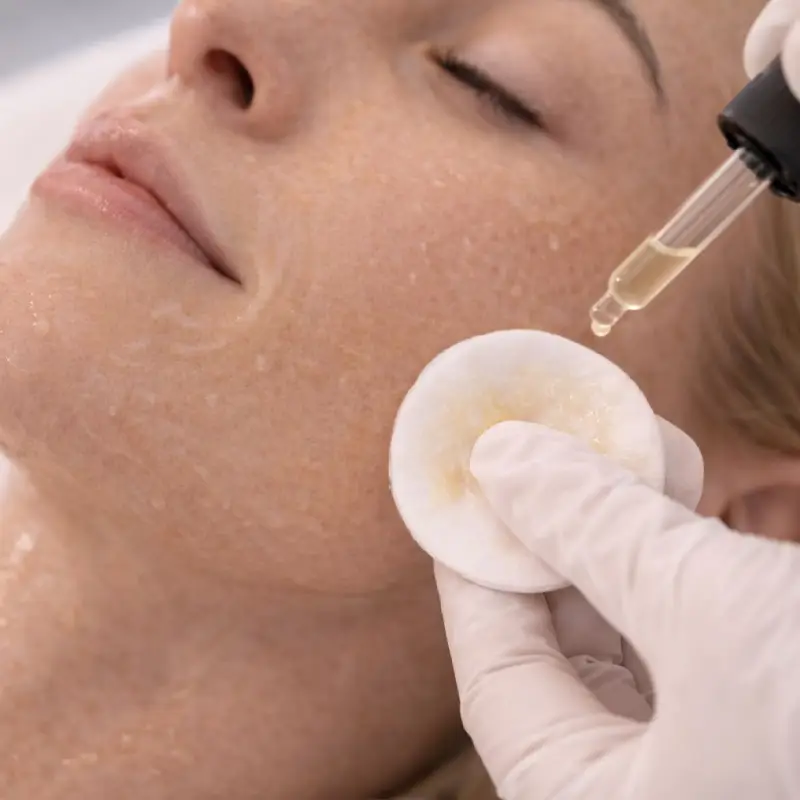 chemical peel