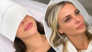 Russian Lip Filler for Thin Lips